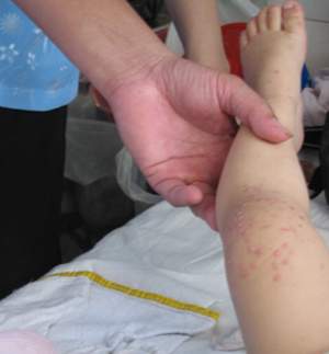 Nhận biết sớm và phòng ngừa bệnh sởi
