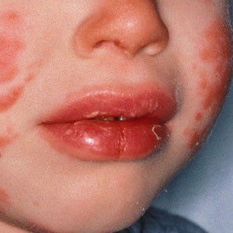 Bệnh dịch và bệnh… lạ ở trẻ - 1
